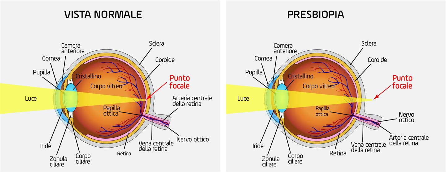 Presbiopia dell'occhio: cos'è, come correggerla con le lenti